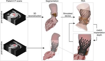 Sealing Behavior in Transcatheter Bicuspid and Tricuspid Aortic Valves Replacement Through Patient-Specific Computational Modeling